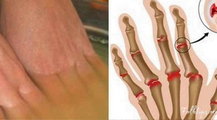 ვაშლის ძმარი ართრიტის წინააღმდეგ, ეს უნდა იცოდეთ !