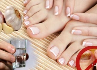 ფრჩხილის სოკოს მკურნალობა ხალხური მეთოდებით. დაუბრუნეთ თქვენს ფეხებს სილამაზე და ჯანმრთელობა