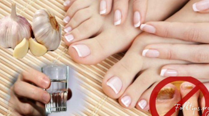 ფრჩხილის სოკოს მკურნალობა ხალხური მეთოდებით. დაუბრუნეთ თქვენს ფეხებს სილამაზე და ჯანმრთელობა