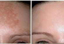 პიგმენტური ლაქები ამ რეცეპტების წინააღმდეგ უძლურნი არიან, შედეგი – 100%-ით სუფთა სახე !