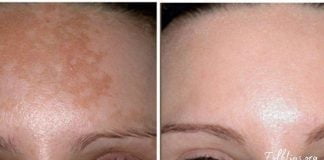 პიგმენტური ლაქები ამ რეცეპტების წინააღმდეგ უძლურნი არიან, შედეგი – 100%-ით სუფთა სახე !