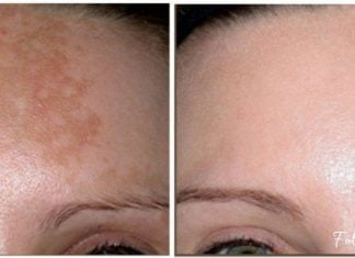 პიგმენტური ლაქები ამ რეცეპტების წინააღმდეგ უძლურნი არიან, შედეგი – 100%-ით სუფთა სახე !