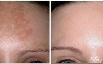 პიგმენტური ლაქები ამ რეცეპტების წინააღმდეგ უძლურნი არიან, შედეგი – 100%-ით სუფთა სახე !