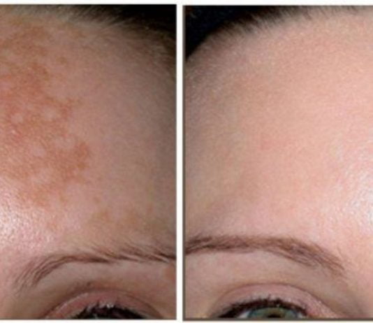 პიგმენტური ლაქები ამ რეცეპტების წინააღმდეგ უძლურნი არიან, შედეგი – 100%-ით სუფთა სახე !