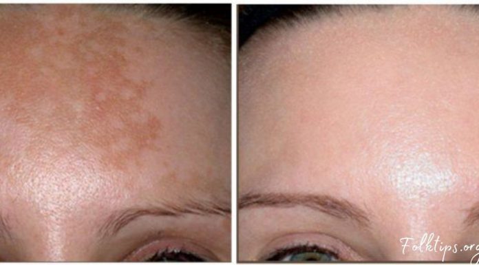 პიგმენტური ლაქები ამ რეცეპტების წინააღმდეგ უძლურნი არიან, შედეგი – 100%-ით სუფთა სახე !