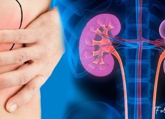 იდეალური საშუალება თირკმლებში გაჩენილი კენჭების წინააღმდეგ. ეფექტურია