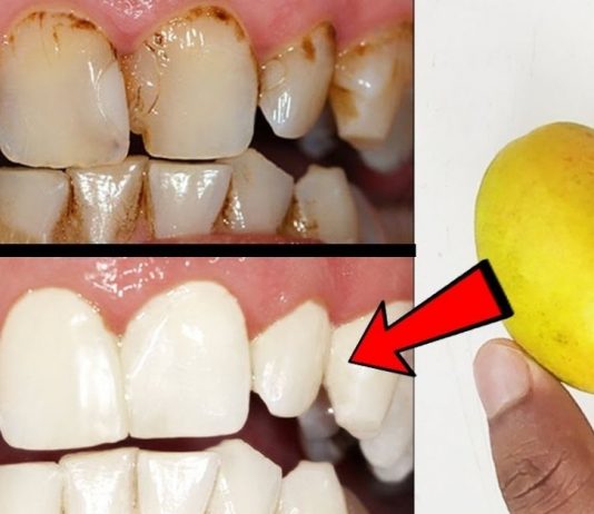 როგორ უნდა გაითეთროთ კბილები 2 წუთში? ყველაზე სწრაფი და ეფექტური მეთოდია