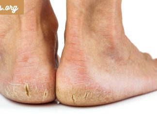 მეთოდი,რომლის შემდეგიც გაგაოცებთ.დაბზარული ქუსლების მკურნალობა და ფეხებზე კანის მოვლის მარტივი წესები.