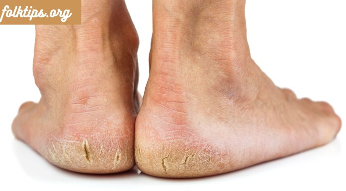 მეთოდი,რომლის შემდეგიც გაგაოცებთ.დაბზარული ქუსლების მკურნალობა და ფეხებზე კანის მოვლის მარტივი წესები.