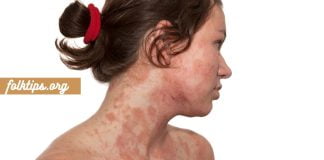 ყველასთვის საინტერესო კანის დაავადება – დერმატიტი ,გამომწვევი მიზეზები.