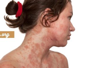 ყველასთვის საინტერესო კანის დაავადება – დერმატიტი ,გამომწვევი მიზეზები.