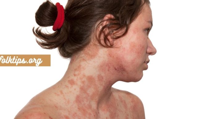 ყველასთვის საინტერესო კანის დაავადება – დერმატიტი ,გამომწვევი მიზეზები.