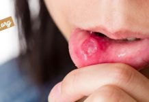 სტომატიტი – მკურნალობა ხალხური საშუალებებით.