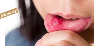 სტომატიტი – მკურნალობა ხალხური საშუალებებით.