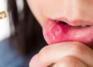 სტომატიტი – მკურნალობა ხალხური საშუალებებით.