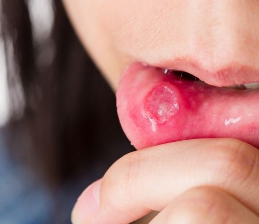 სტომატიტი – მკურნალობა ხალხური საშუალებებით.