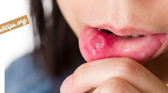 სტომატიტი – მკურნალობა ხალხური საშუალებებით.