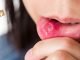 სტომატიტი – მკურნალობა ხალხური საშუალებებით.