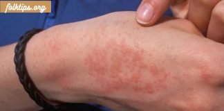 საიდან მოდის სიცივის ალერგია და როგორ გავუმკლავდეთ მას.