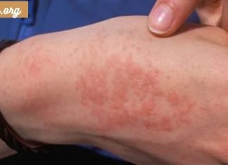 საიდან მოდის სიცივის ალერგია და როგორ გავუმკლავდეთ მას.