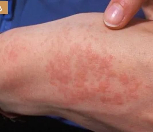 საიდან მოდის სიცივის ალერგია და როგორ გავუმკლავდეთ მას.