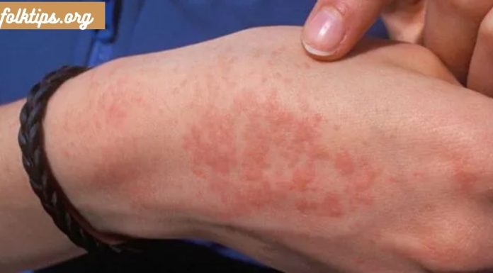 საიდან მოდის სიცივის ალერგია და როგორ გავუმკლავდეთ მას.