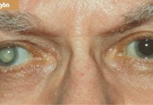 თვალები გებინდებათ და მკვეთრად ვეღარ ხედავთ ? ნახთ მიზეზები და მკურნალობის მეთოდები.