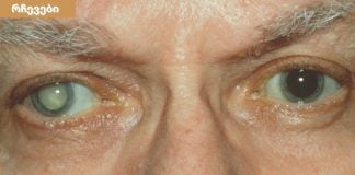 თვალები გებინდებათ და მკვეთრად ვეღარ ხედავთ ? ნახთ მიზეზები და მკურნალობის მეთოდები.