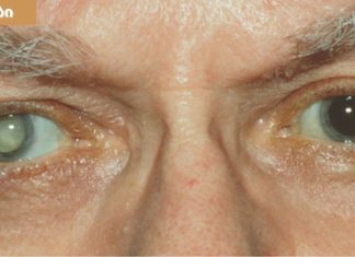 თვალები გებინდებათ და მკვეთრად ვეღარ ხედავთ ? ნახთ მიზეზები და მკურნალობის მეთოდები.