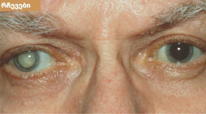 თვალები გებინდებათ და მკვეთრად ვეღარ ხედავთ ? ნახთ მიზეზები და მკურნალობის მეთოდები.