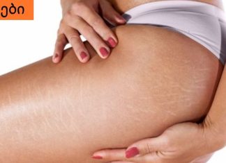 როგორ მოვიშოროთ სტრიები სხეულზე.