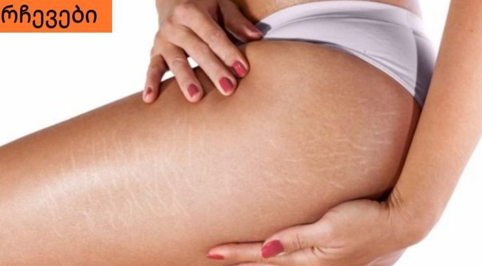 როგორ მოვიშოროთ სტრიები სხეულზე.