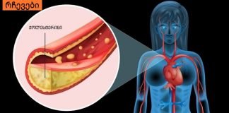 სასიცოცხლოდ მნიშვნელოვანი სისხლძარღვების ათეროსკლეროზის პირველი სიმპტომები