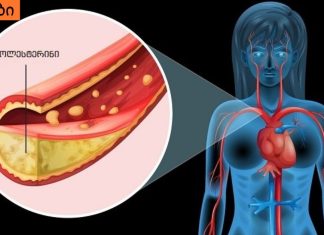 სასიცოცხლოდ მნიშვნელოვანი სისხლძარღვების ათეროსკლეროზის პირველი სიმპტომები