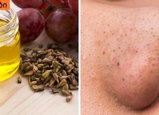 როგორ მოვიშოროთ შავი წერტილები სამუდამოდ,ყველაზე მარტივი რეცეპტი.