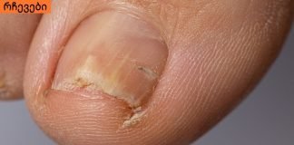 ჩაზრდილი ფრჩხილი განგრენას იწვევს, ეს აუცილებლად უნდა ნახოთ !