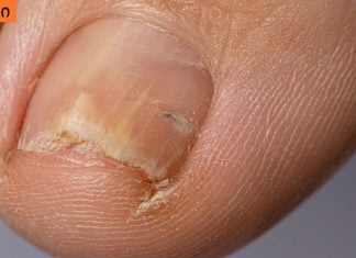 ჩაზრდილი ფრჩხილი განგრენას იწვევს, ეს აუცილებლად უნდა ნახოთ !