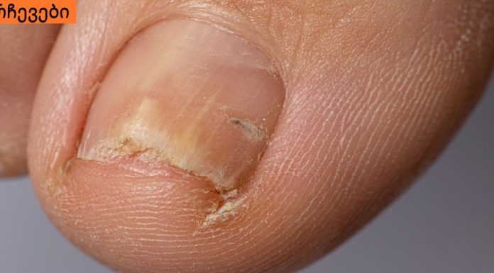 ჩაზრდილი ფრჩხილი განგრენას იწვევს, ეს აუცილებლად უნდა ნახოთ !