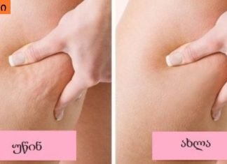 როგორ გავთავისუფლდეთ ცელულიტისგან? 100%-იანი შედეგი მხოლოდ 1 კვირაში