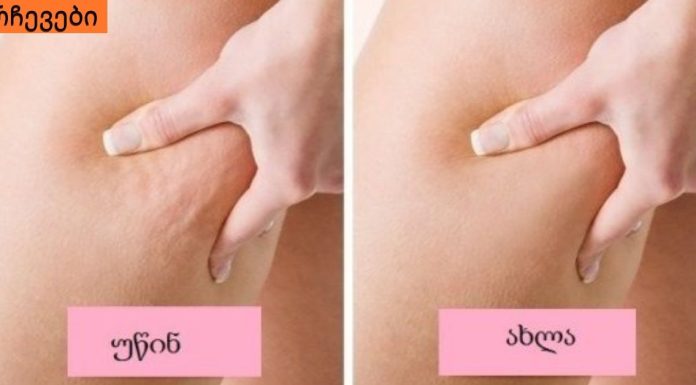 როგორ გავთავისუფლდეთ ცელულიტისგან? 100%-იანი შედეგი მხოლოდ 1 კვირაში