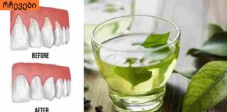 ღრძილის რეტრაქციას ეს 4 ინგრედიენტი შველის! რთული პრობლემის მარტივი გადაწყვეტა!