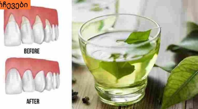 ღრძილის რეტრაქციას ეს 4 ინგრედიენტი შველის! რთული პრობლემის მარტივი გადაწყვეტა!