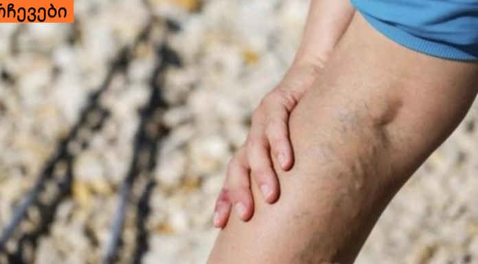 ვინ შეიძლება იყოს თრომბოზის რისკის ქვეშ და რამდენად საშიშია ის?