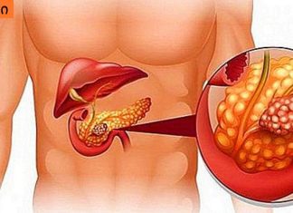 პანკრეასის ანთების ადრეული ნიშნები. გულის რევა ,ღებინება,სხვა დაავადებაშ არ შეგეშალოთ.