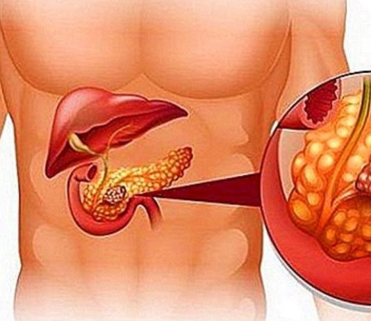 პანკრეასის ანთების ადრეული ნიშნები. გულის რევა ,ღებინება,სხვა დაავადებაშ არ შეგეშალოთ.