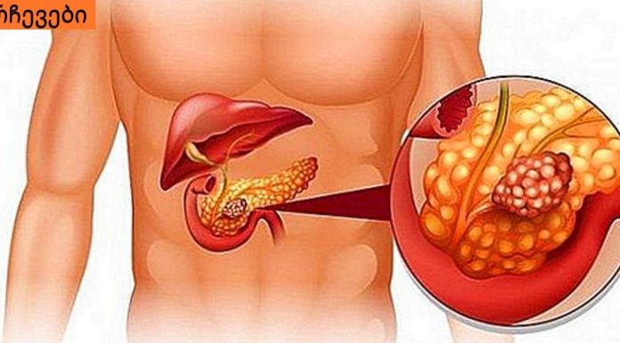 პანკრეასის ანთების ადრეული ნიშნები. გულის რევა ,ღებინება,სხვა დაავადებაშ არ შეგეშალოთ.