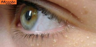 ეს ყველას აწუხებს, სახეზე და ტანზე თეთრი ცხიმგროვების გაჩენის მიზეზი, იხილეთ.