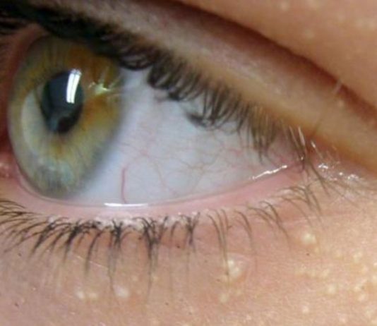 ეს ყველას აწუხებს, სახეზე და ტანზე თეთრი ცხიმგროვების გაჩენის მიზეზი, იხილეთ.