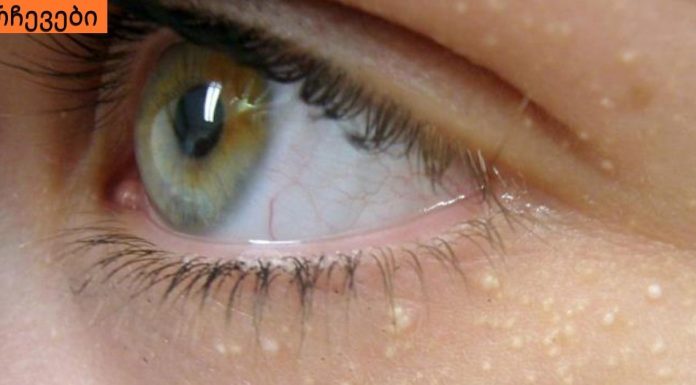 ეს ყველას აწუხებს, სახეზე და ტანზე თეთრი ცხიმგროვების გაჩენის მიზეზი, იხილეთ.