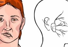 როგორ დავადგინოთ ინსულტი? მარტივი მეთოდი, რომლითაც ადამიანის სიცოცხლეს გადაარჩენთ.